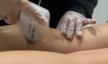 Depilação a Laser