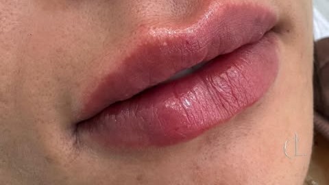 Preenchimento Facial
